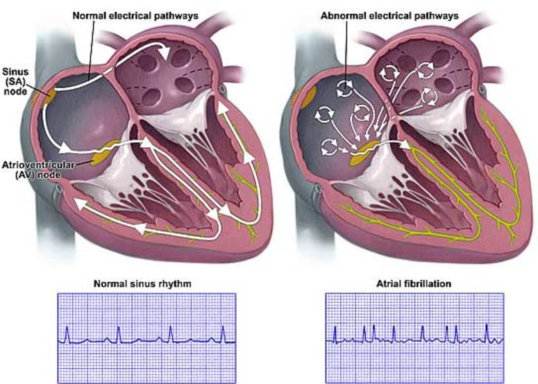 Normal & Abnormal Electrical Pathways of the Heart 