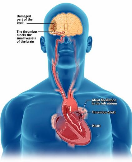 Why does Atrial Fibrillation (AFib) increase stroke risk? | Dr Jose Osorio