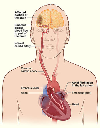 Strokes caused by Afib are due to clots that form in the heart and can travel (embolize) to the brain