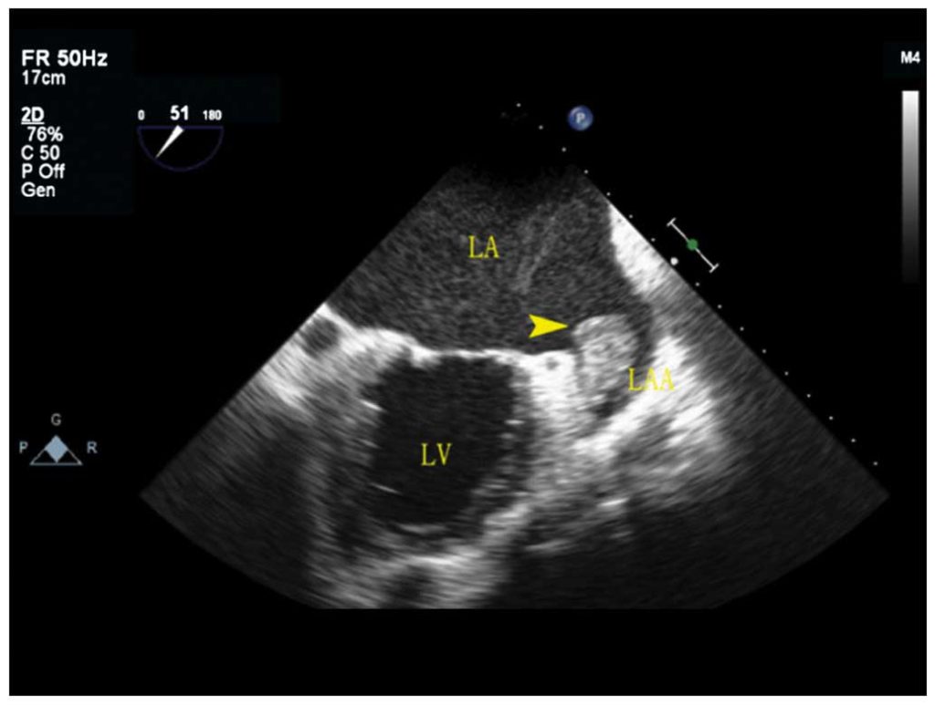 Large clot in the left atrial appendage, where a watchman device can be implanted to prevent strokes