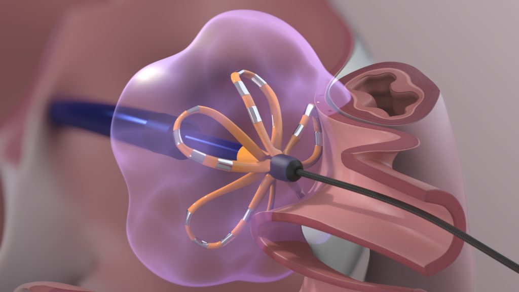 Pulsed Field Ablation (PFA) using the Farapulse device