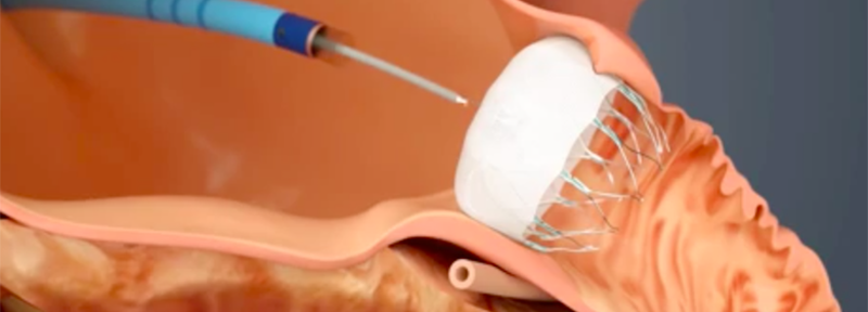 Left atrial appendage occluded by the watchman device