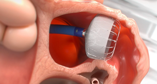 Left Atrial Appendage Closure using the watchman FLX device