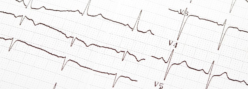 EKG reading of normal sinus rhythm. EKG is used to diagnose arrhythmias, such as atrial fibrillation. 