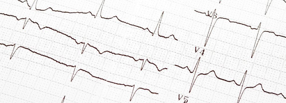 EKG reading of normal sinus rhythm. EKG is used to diagnose arrhythmias, such as atrial fibrillation.